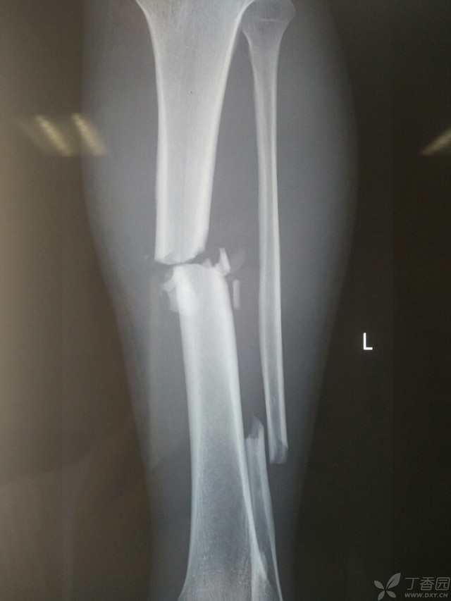 科技重塑脛腓骨骨折康復(fù)之旅，引領(lǐng)未來(lái)體驗(yàn)新篇章