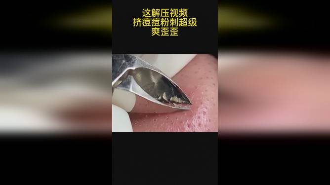 最新擠膿包視頻，見證變化的力量，自信與成就感的誕生之地